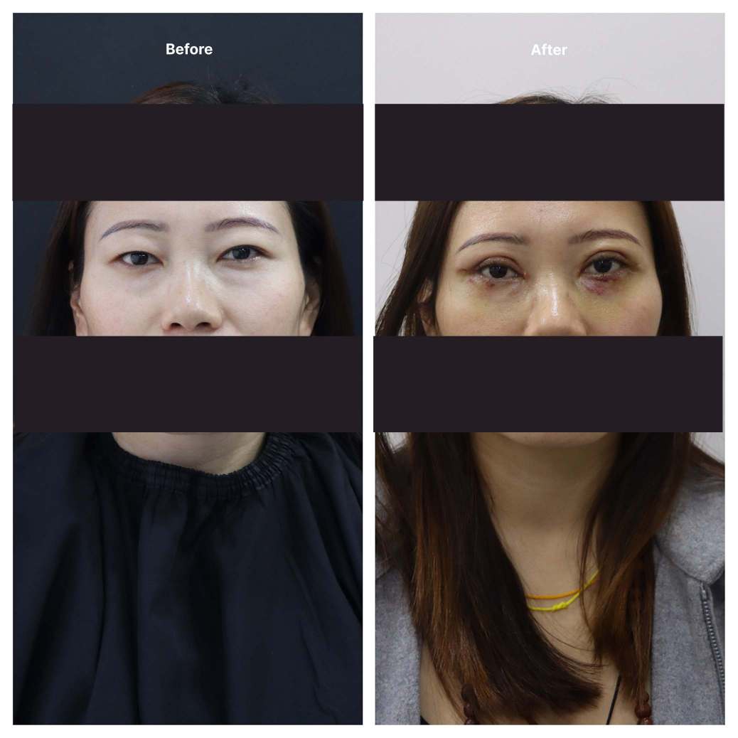 Eyelid Surgery KOQ10